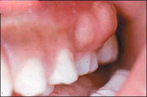 جلوگیری و درمان آبسه دندان