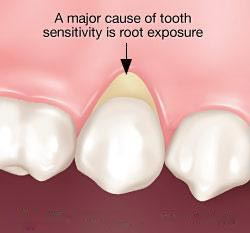 جلوگیری و درمان حساسیت دندان