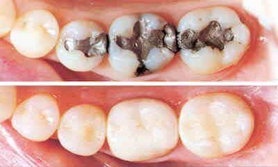 جلوگیری و درمان آبسه دندان